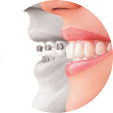 invisalign and braces special