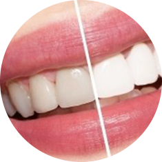 teeth whitening Scarborough