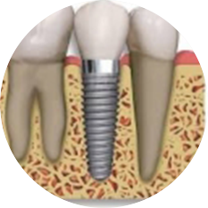 dental implant Scarborough